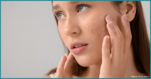 Natural Acne Treatment Northern VA