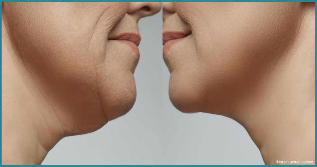 Skin Tightening After GLP-1 Weight Loss in Reston