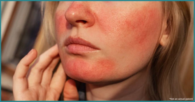 Most Effective Rosacea Treatments in Reston