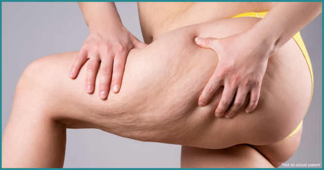 Top Dermatologist Recommended Cellulite Treatment in Northern Virginia