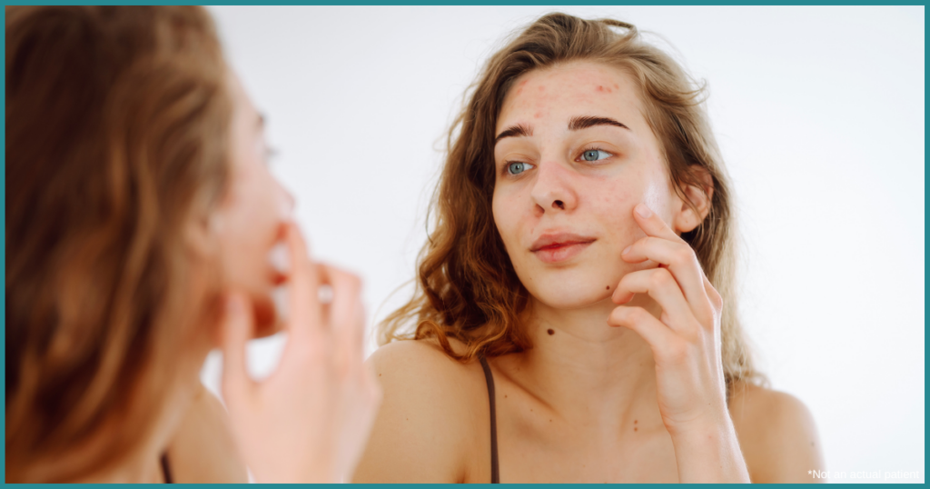 Dermatologist Recommended Acne Treatments in Virginia