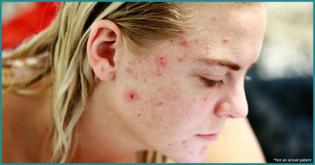 Acne Specialist in Herndon