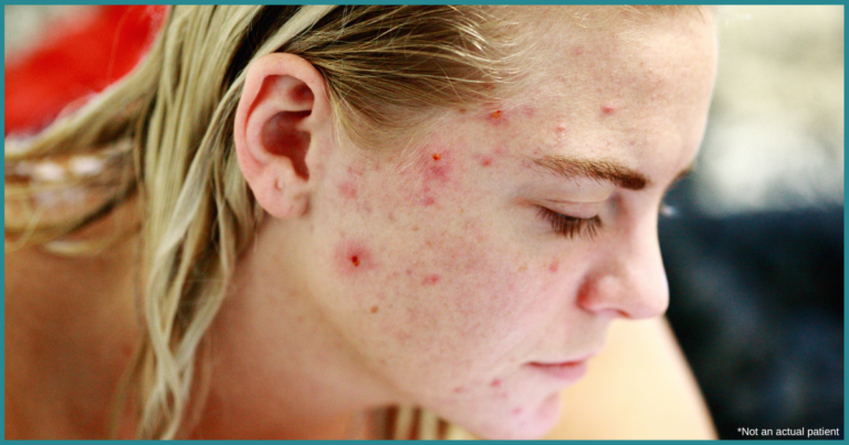 Acne Specialist in Herndon