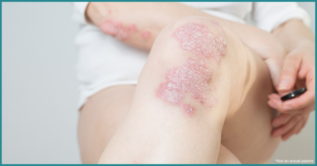 Top 10 Psoriasis FAQ- Psoriasis Awareness Month