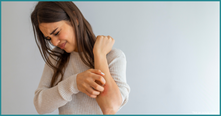 top eczema flare up causes Virginia